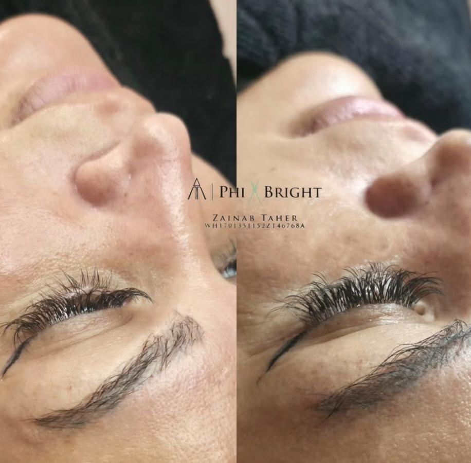 Phi Bright skin treatment before and after
