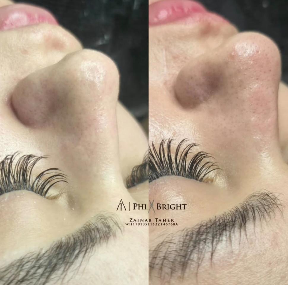Phi Bright skin treatment before and after
