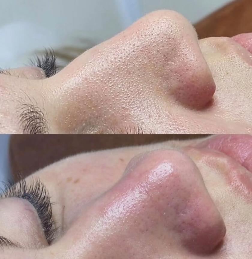 Deep skin cleaning before and after